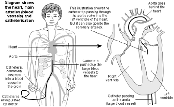 Cardiac-Catherization-and-Coronary-Angiography