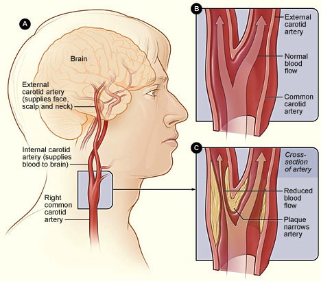 carotid-artery-disease