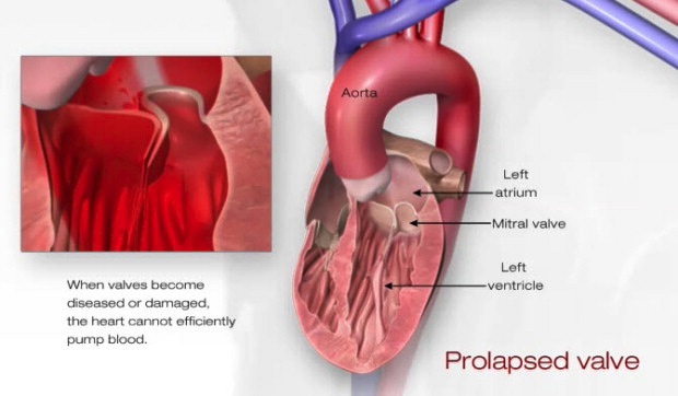 mitral-valve-prolapse
