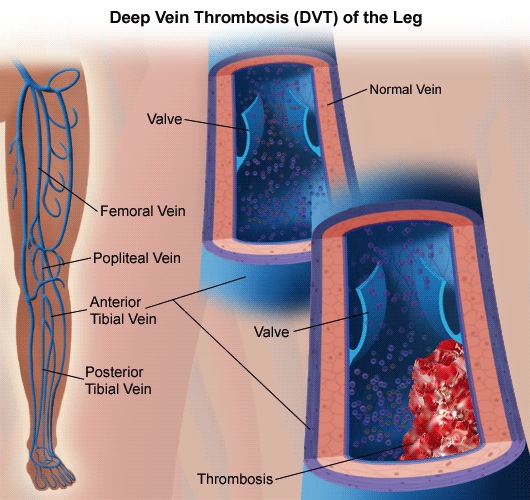 Deep Vein Thrombosis for Fort Collins, CO, Apex Endovascular